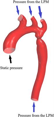 Validation and Diagnostic Performance of a CFD-Based Non-invasive Method for the Diagnosis of Aortic Coarctation